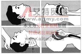 图7-1开放气道操作